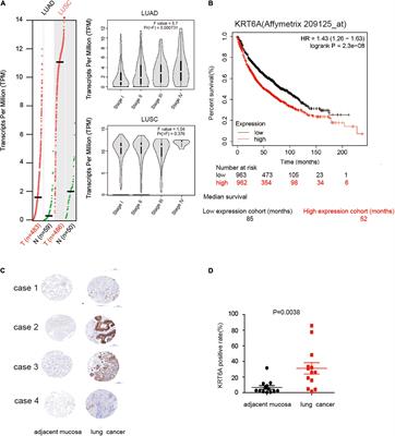 KRT6A Promotes Lung Cancer Cell Growth and Invasion Through MYC-Regulated Pentose Phosphate Pathway